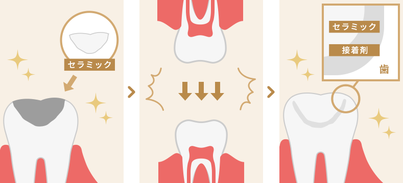 歯と一体化して隙間ができない接着剤を使用の図