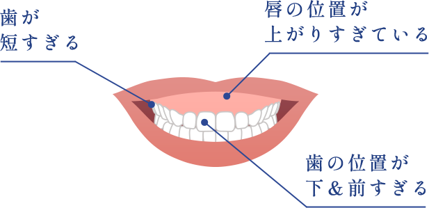 歯が短すぎる 唇の位置が上がりすぎている 歯の位置が下＆前すぎる