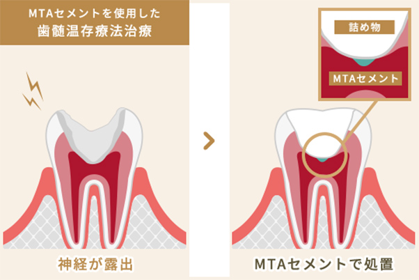 MTAセメントを使用した歯髄温存療法治療