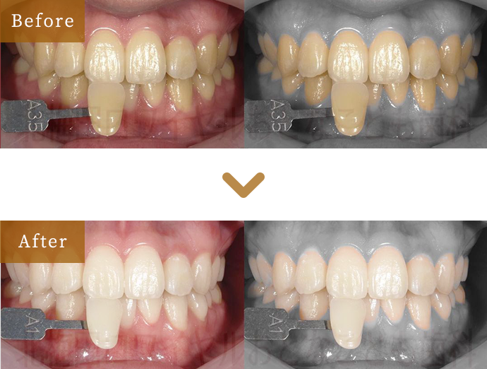 ホワイトニング｜【公式】北梅田ロワイヤルおとなこども歯科矯正歯科｜梅田・歯医者