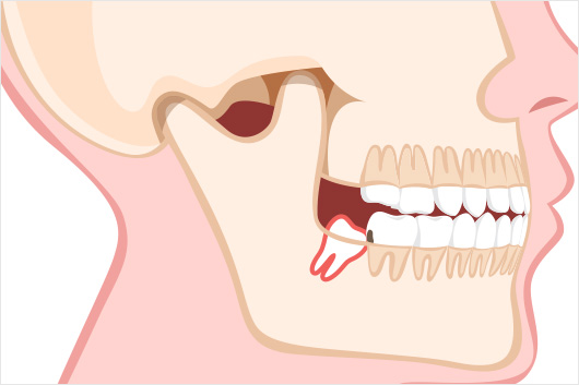 親知らずの影響で、歯磨きがしづらく手前の歯が虫歯になる場合