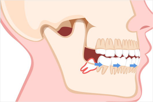 斜めに生えてきたため、横の歯を押して前歯まで歯並びが悪くなる場合